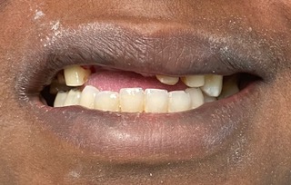 close up of mouth with implant bases for the top two front teeth